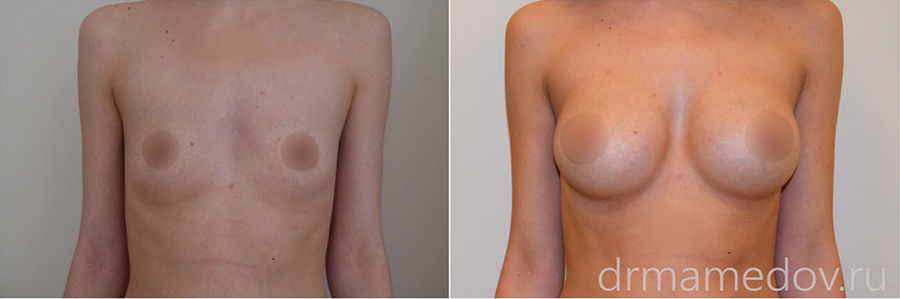 Увеличение груди фото до и после Пациент №5, пластический хирург Мамедов Русиф Бежанович.