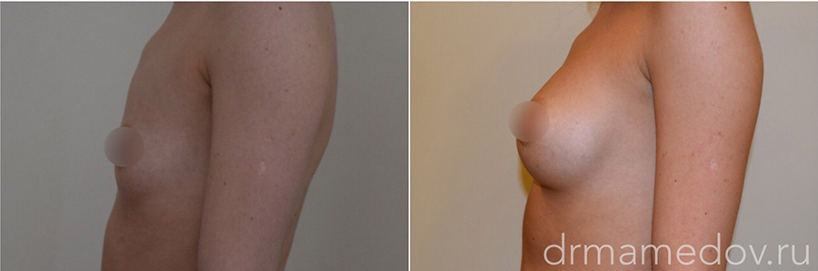 Увеличение груди фото до и после Пациент №5, пластический хирург Мамедов Русиф Бежанович.