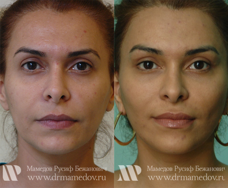 Подтяжка лица фото до и после Пациент №1, пластический хирург Мамедов Русиф Бежанович.