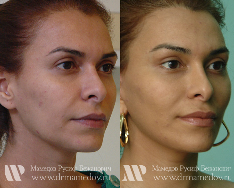 Подтяжка лица фото до и после Пациент №1, пластический хирург Мамедов Русиф Бежанович.