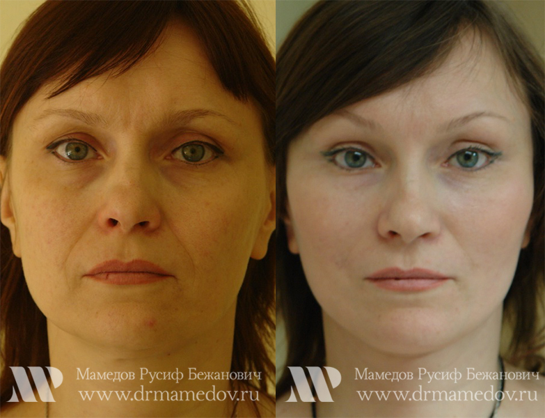 Подтяжка лица фото до и после Пациент №2, пластический хирург Мамедов Русиф Бежанович.