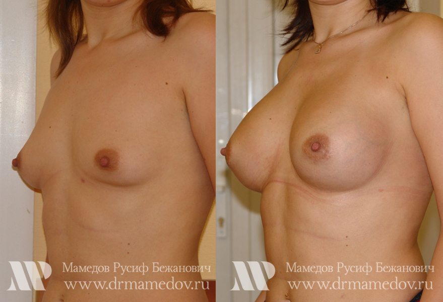Увеличение груди фото до и после Пациент №2, пластический хирург Мамедов Русиф Бежанович.