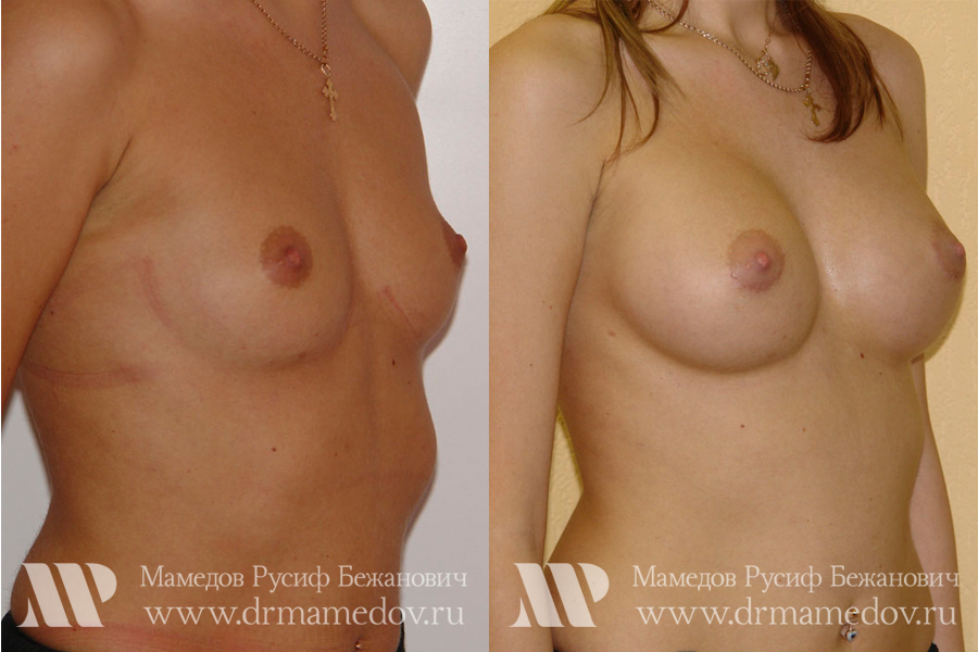 Увеличение груди фото до и после Пациент №3, пластический хирург Мамедов Русиф Бежанович.