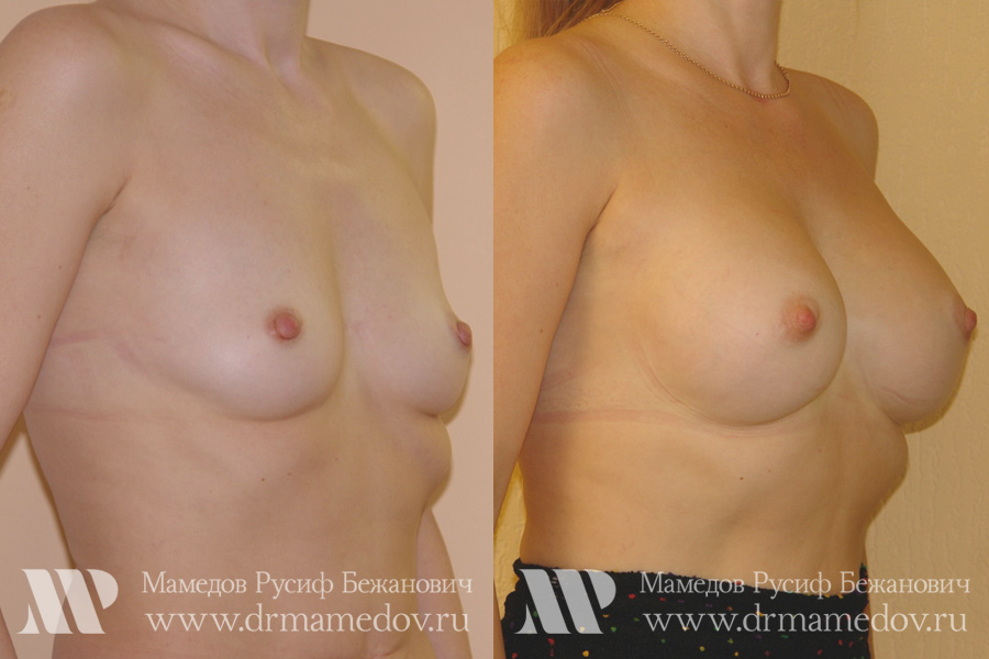 Увеличение груди фото до и после Пациент №4, пластический хирург Мамедов Русиф Бежанович.