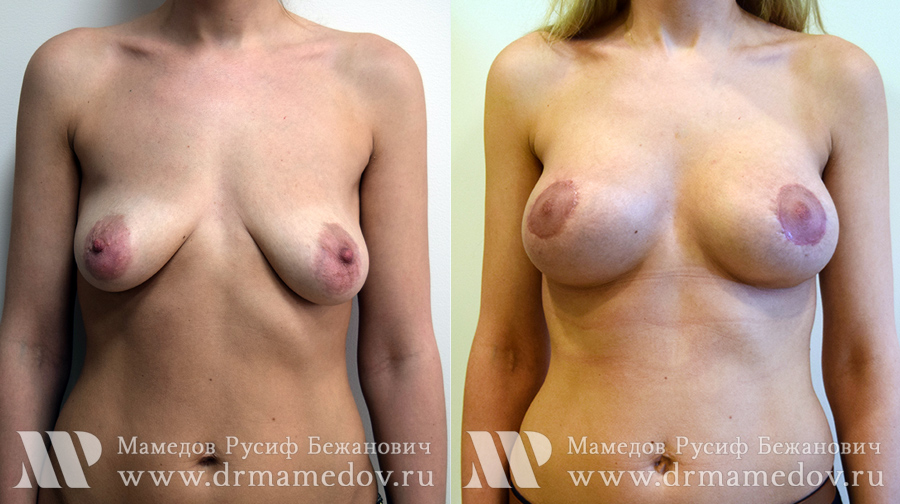 Подтяжка груди фото до и после Пациент №1, пластический хирург Мамедов Русиф Бежанович.