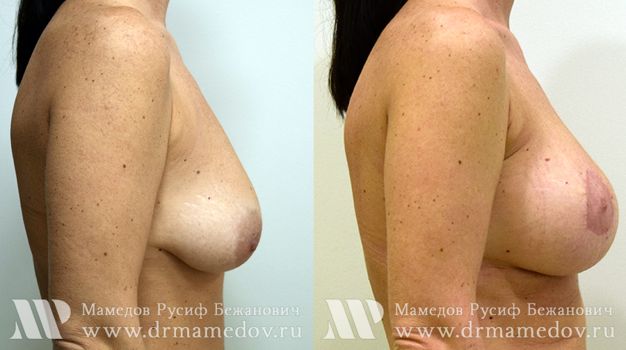 Подтяжка груди фото до и после Пациент №2, пластический хирург Мамедов Русиф Бежанович.