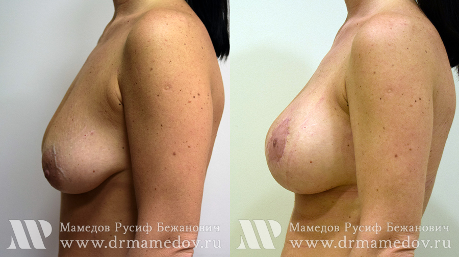 Подтяжка груди фото до и после Пациент №2, пластический хирург Мамедов Русиф Бежанович.