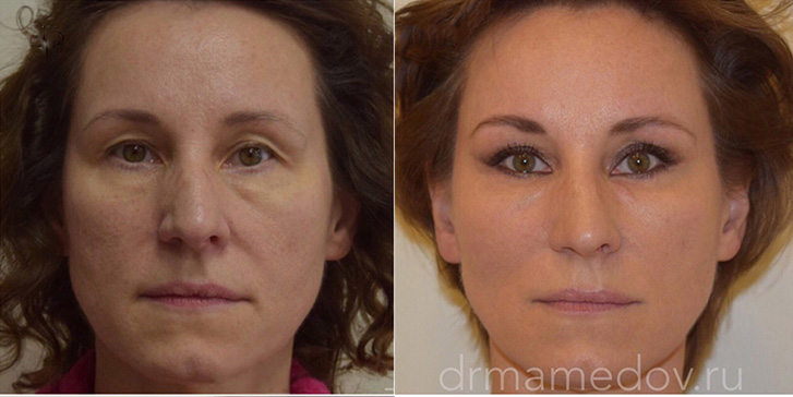 Подтяжка лица фото до и после Пациент №4, пластический хирург Мамедов Русиф Бежанович.