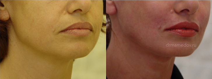 Подтяжка лица фото до и после Пациент №5, пластический хирург Мамедов Русиф Бежанович.