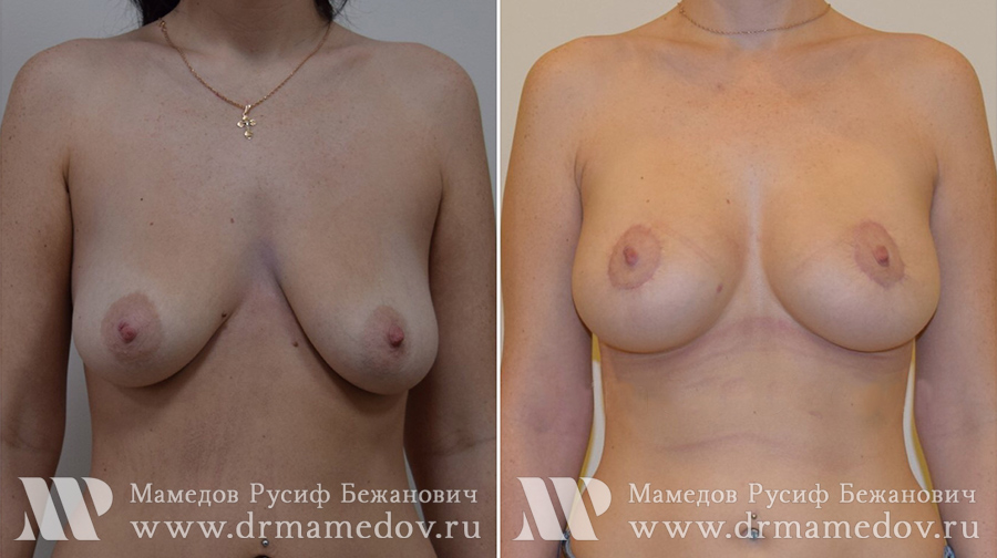 Подтяжка груди фото до и после Пациент №3, пластический хирург Мамедов Русиф Бежанович.