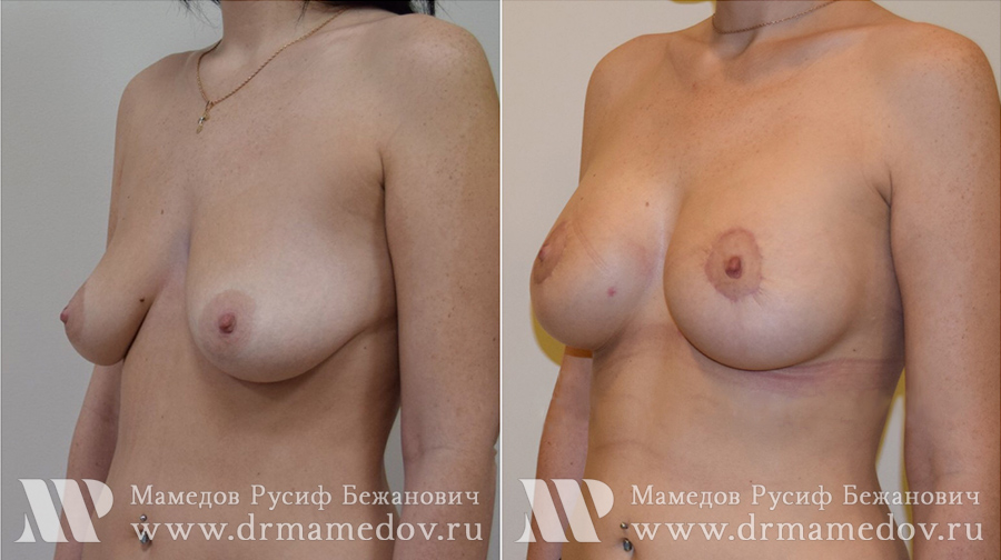 Подтяжка груди фото до и после Пациент №3, пластический хирург Мамедов Русиф Бежанович.