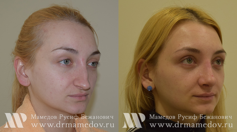 Ринопластика фото до и после Пациент №3, пластический хирург Мамедов Русиф Бежанович.