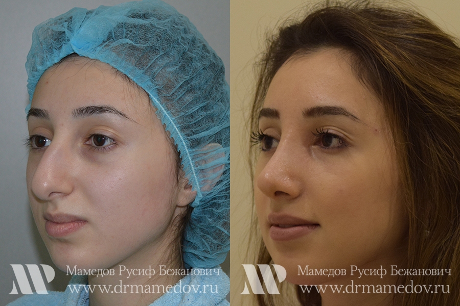 Ринопластика фото до и после Пациент №2, пластический хирург Мамедов Русиф Бежанович.