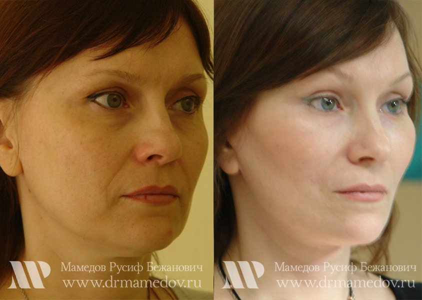 Подтяжка лица фото до и после Пациент №2, пластический хирург Мамедов Русиф Бежанович.